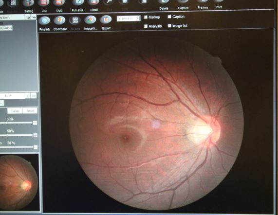 Retina and optic nerves inside an eye test result for lasik eye surgery in Korea