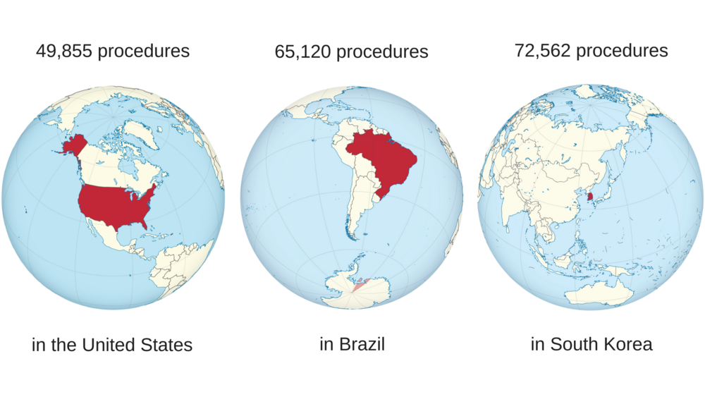 View of different countries and number of rhinoplasty procedures, including rhinoplasty in Korea