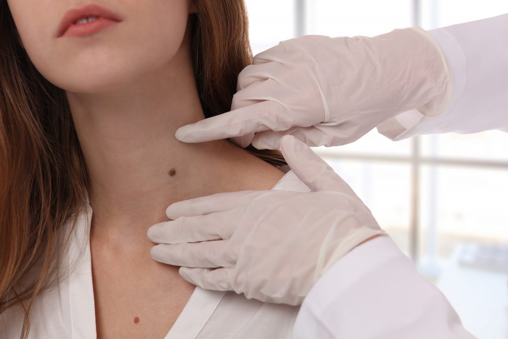 mole removal consultation