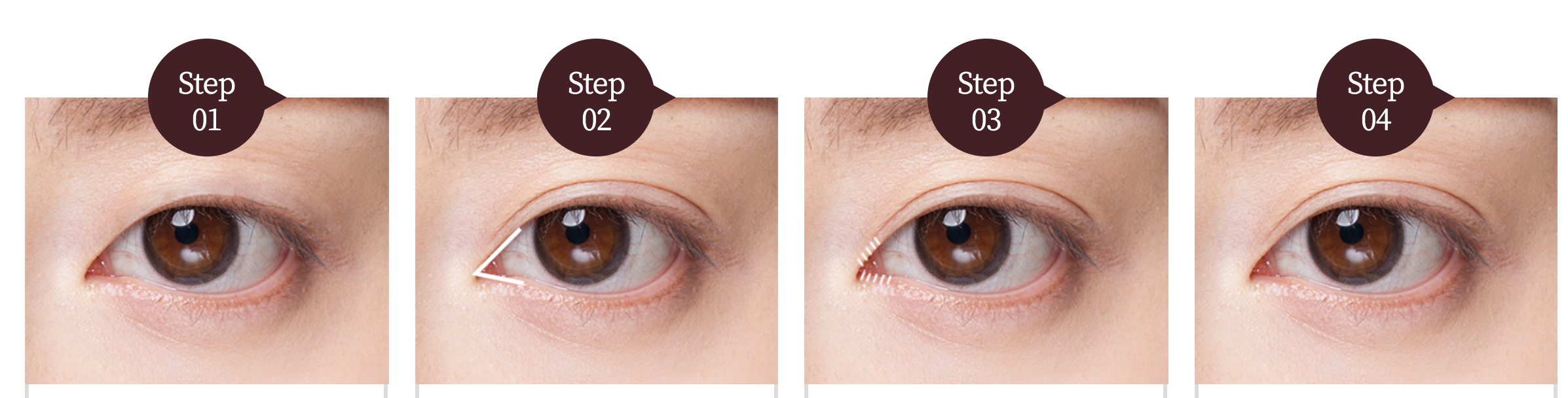 eye plastic surgery steps