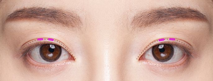 double eyelid surgery korea