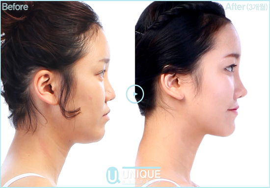 nose job in korea before and after