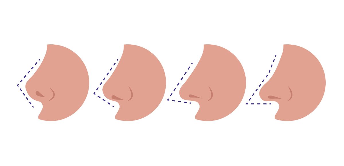 nose tip surgery