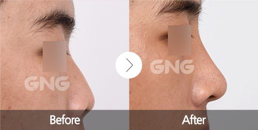 nose_job in korea before and after