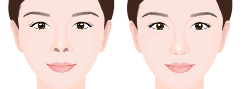 short nose surgery