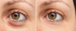 before-and-after-eye-bag-removal-surgery