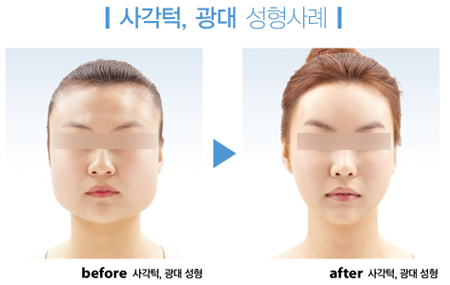 Jaw reduction surgery korea before after 2