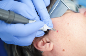 mole-removal-korea-jivaka-care