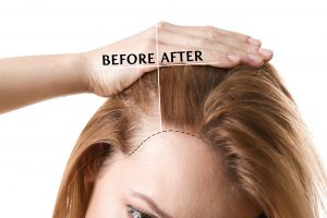 hair transplant korea