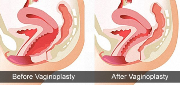 before-and-after-vaginoplasty
