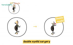 korean-double-eyelid-surgery