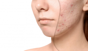 patient-with-acne-scars-cross-section