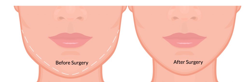 v line surgery