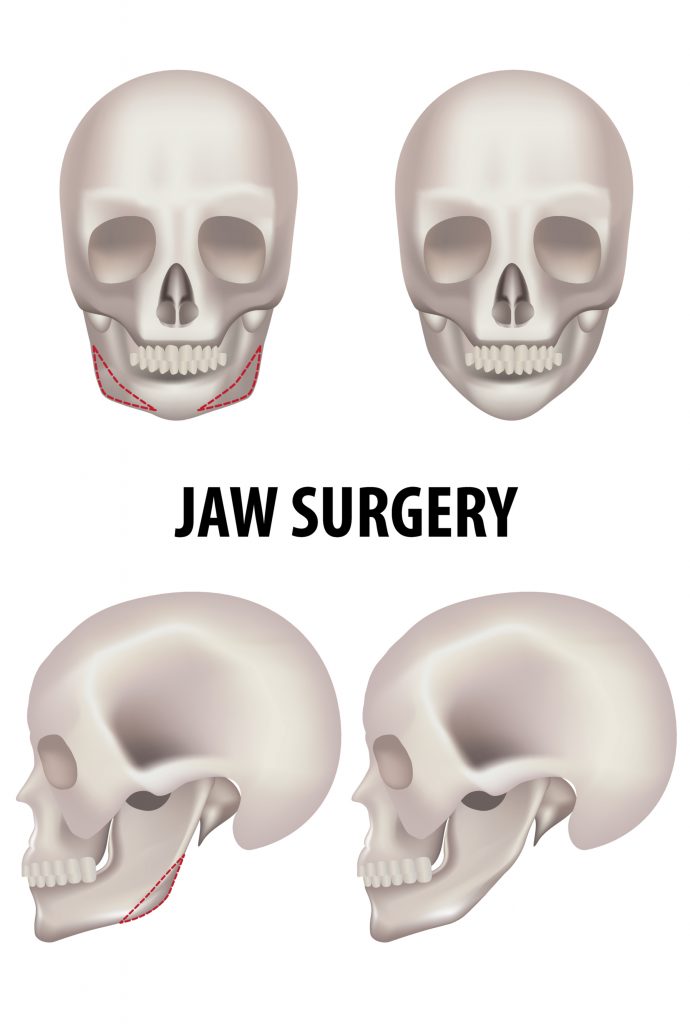 v line surgery